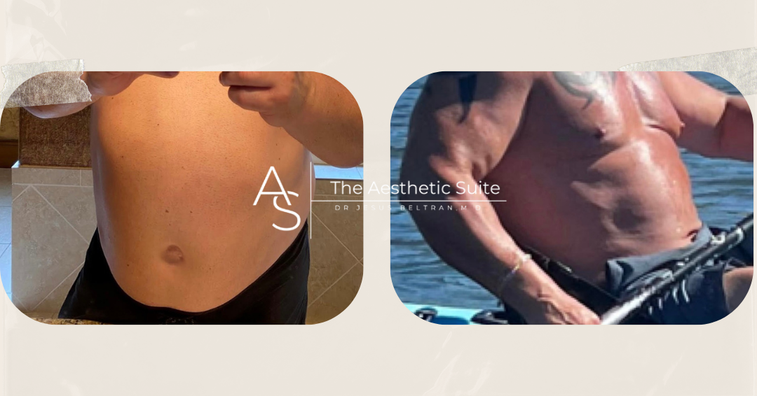gas pains semaglutide Gas pain is an extremely common, and uncomfortable side effect of GLP-1  therapy, but there are ways to ease it. Watch to learn our top 5 practical  tips to help you reduce